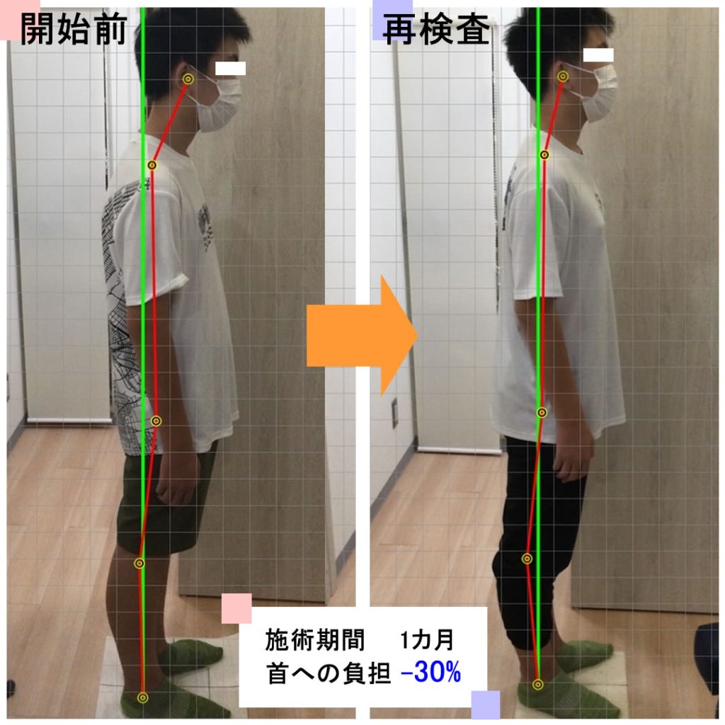 姿勢習慣プログラム症例1
