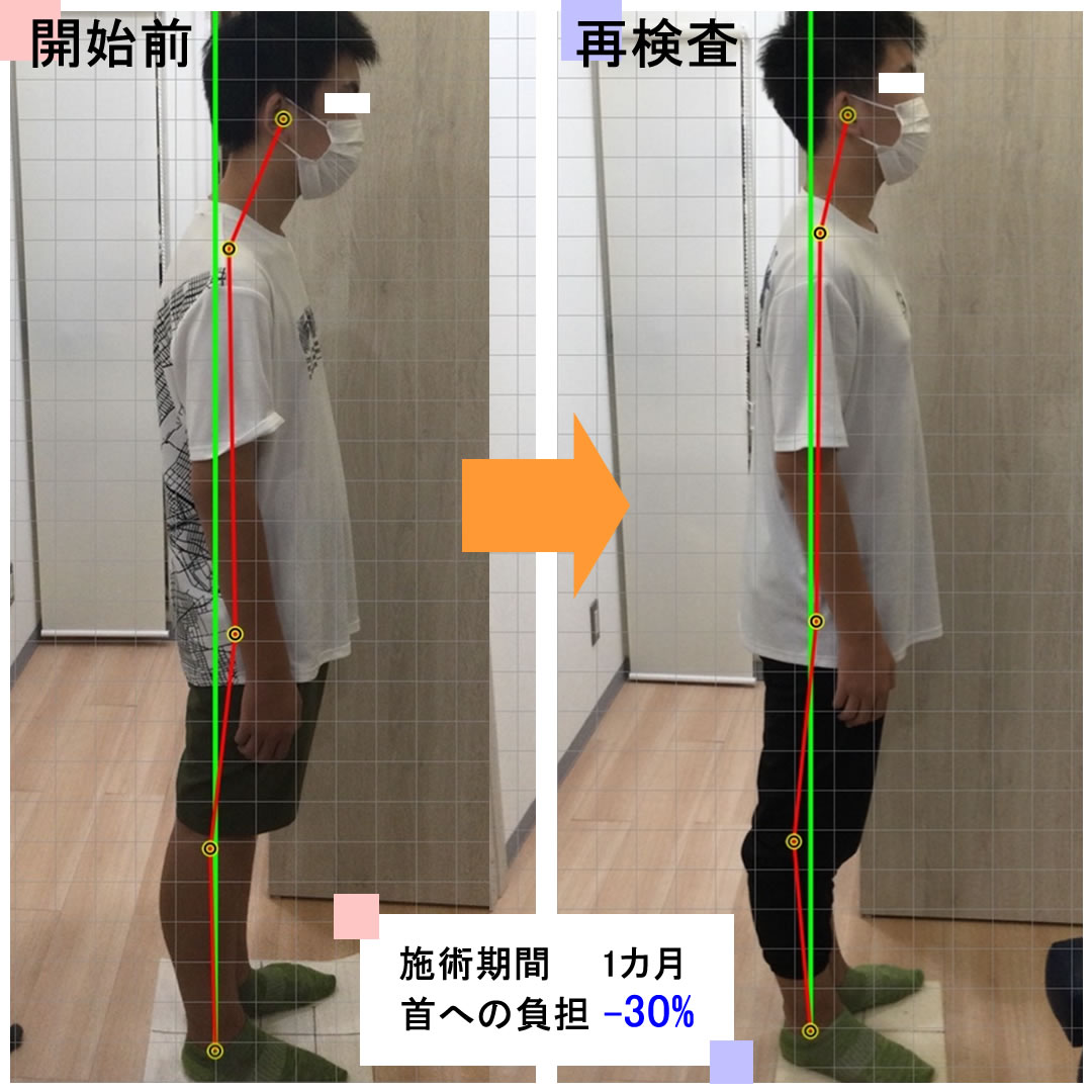 姿勢習慣プログラム症例1