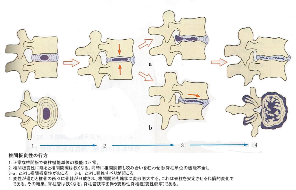 腰部椎間板ヘルニアの行方の図