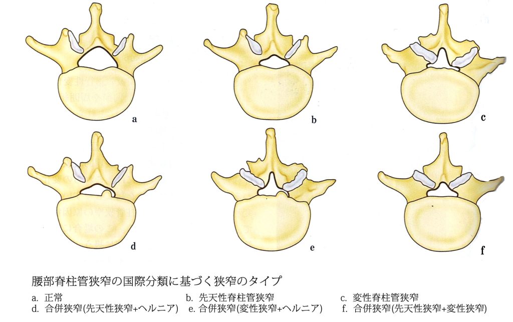 腰部脊柱管狭窄の国際分類
